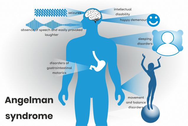 Diagram showing common features of Angelman syndrome, including seizures, speech absence, happy demeanour, intellectual disability, sleeping disorders, gastrointestinal motility issues, and movement and balance disorders